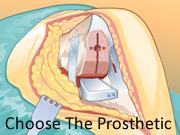 Choose The Prosthetic
