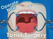 Operate now! Tonsil Surgery